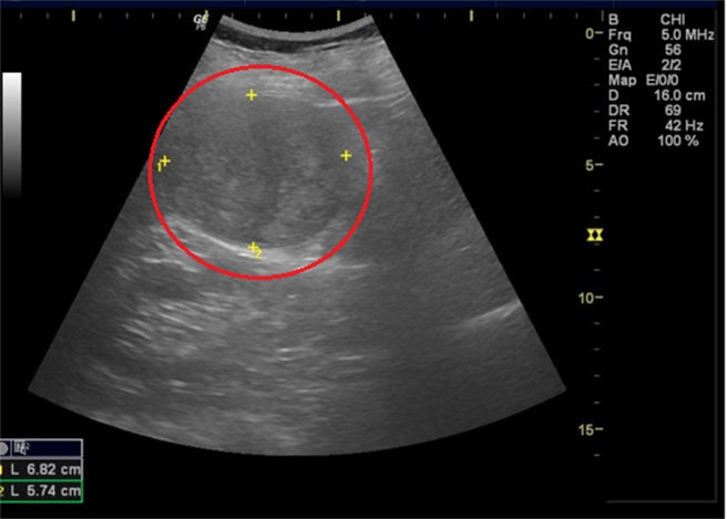 69岁陈姓妇人因体检抽血报告显示C肝病毒量和肝癌指数都偏高，进一步接受超音波检查时发现肝臟右叶有约7公分大的肿瘤。（冯惠宜摄）