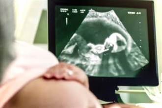 超音波照到2張臉卻只懷一胎 孕婦驚：流掉的孩子回來了