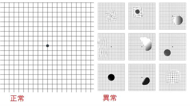 直線總看成弧線？醫示警：當心已是「眼睛癌症」 - 健康- 中時新聞網