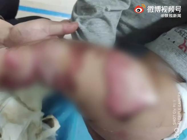 西安一名1岁男童日前没穿尿布睡在电热毯上，不料因为尿床，导致下肢、腰背烧烫伤。（图／翻摄自微博）