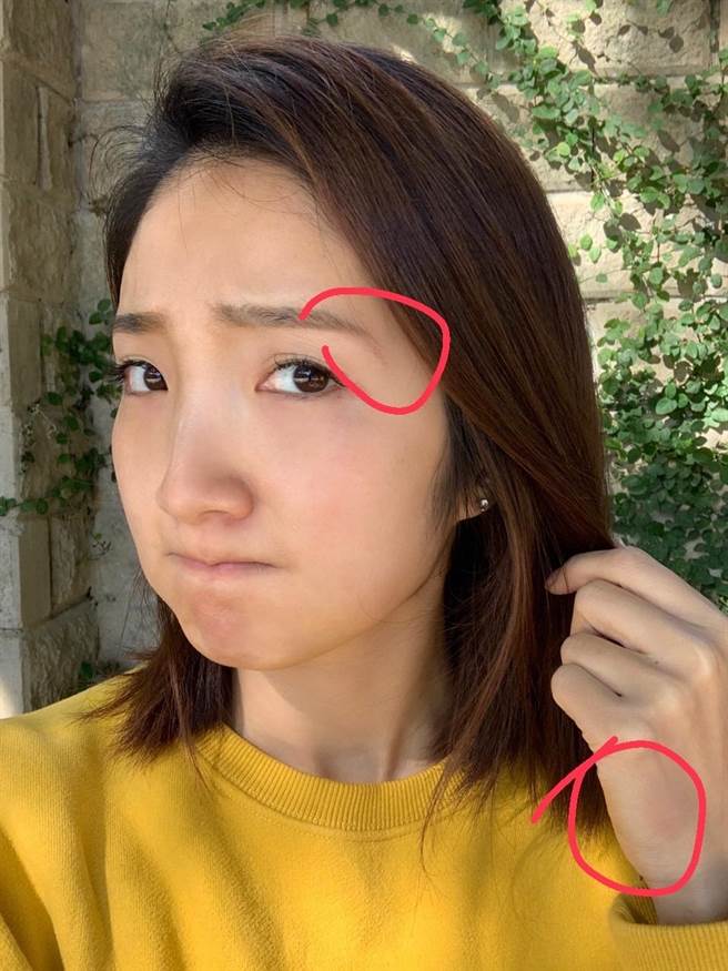 許瀞蔆慶辛只有眉尾及手背小小挫傷（紅圈處）。（亞樂傳播提供）