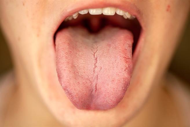 久咳不癒，恐釀成大病！一名60歲的病患，咳了大半年都沒好，醫師一看發現舌苔變色，竟已癌症末期。示意圖非當事人。(達志影像)