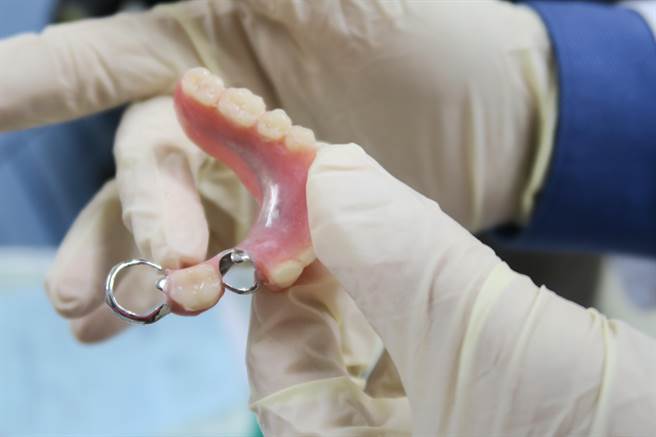 82歲的林老阿嬤因為口內的假牙太老舊，內鉤變形後不斷刮傷右舌，導致反覆發炎、潰瘍，最後竟因此罹患舌癌。（謝瓊雲攝）