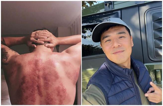 窦智孔背部刮痧如被虐打痕迹。（窦智孔提供）