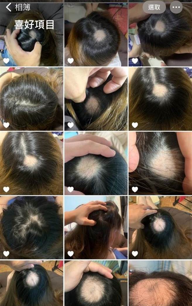 一名24岁的女网友在打完第一剂莫德纳疫苗后开始落髮，且随着时间过去越来越严重，从原本硬币大小的秃头，转变成鸡蛋大小。（图／翻摄自Dcard）