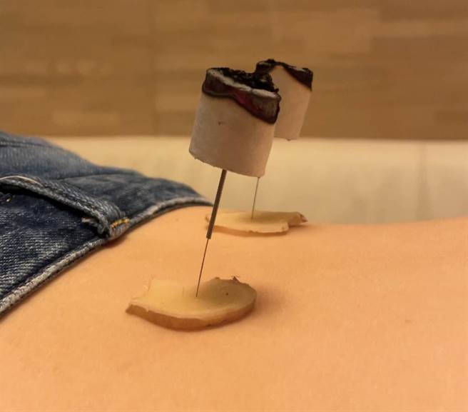 寒性下背痛，中医可以「灸疗」纾解。(图/刘昱呈中医师提供)