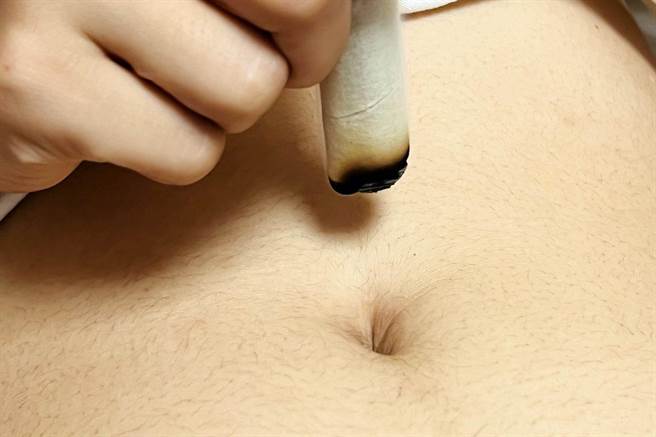 艾灸肚臍周圍特定穴位，配合醫師治療，溫女士病情控制穩定。圖為艾灸示意照。（台北慈濟醫院提供）