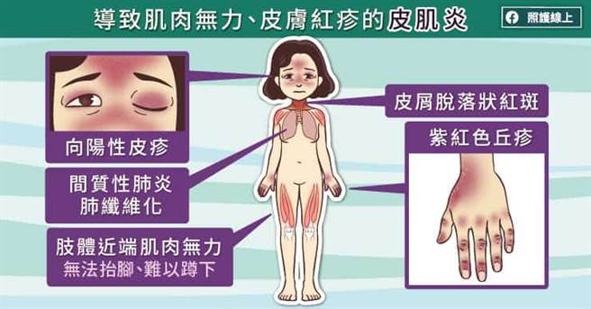 (图/照护线上提供)