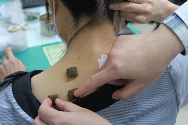 中医三九贴的治疗方式，可以改过敏性鼻炎、也能用来改善体质虚寒者在冬季容易出现的手脚冰冷、腹泻等症状。（谢琼云摄）