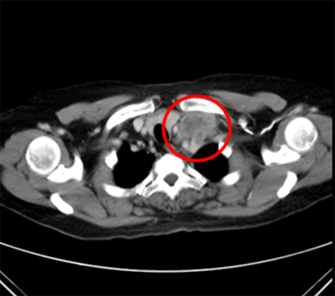 治疗前，颈部肿瘤5x3公分。（童综合医院提供／陈淑娥台中传真）