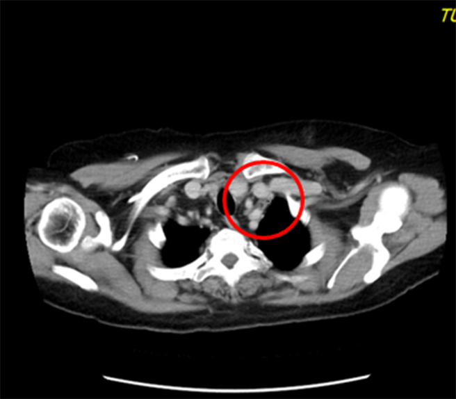 治疗后，颈部肿瘤2x1公分。（童综合医院提供／陈淑娥台中传真）