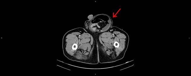 黄善鸿医师指出，透过电脑断层显示两腿间的突出物为巨大的嵌顿性腹股沟疝气（台北医院提供／戴上容新北传真）