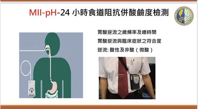 （24小时导管式食道酸碱度检测必须从鼻腔放置导管至食道，并随身背负纪录主机。图片来源 / 台湾胃肠神经与蠕动学会）