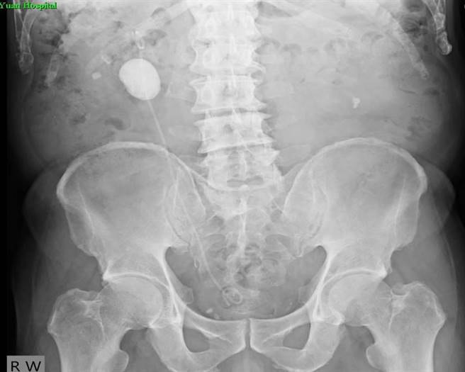 60歲劉姓男子手術前，右腎結石約有 6X5公分大小。（豐原醫院提供／王文吉台中傳真）