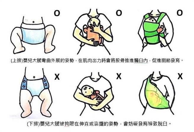 长庚团队提醒家长，应确实将大腿摆在弯曲外展的姿势。（长庚医院提供／林周义台北传真）