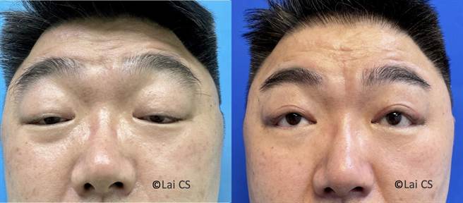 江姓男子动眼睑下垂手术前后对比＞