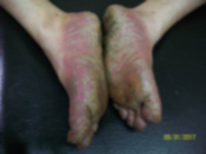 脓疱型乾癣掌拓型，由湿热浸淫所导致，是非常难治的皮肤疾病。(图/洪宏志中医师提供 图片已经过模糊化处理)