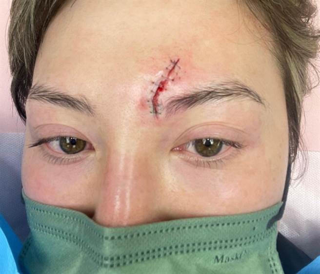 何慈茵工作时挂彩，脸上多了一道3公分长的疤痕。(图/ 摘自何慈茵IG)