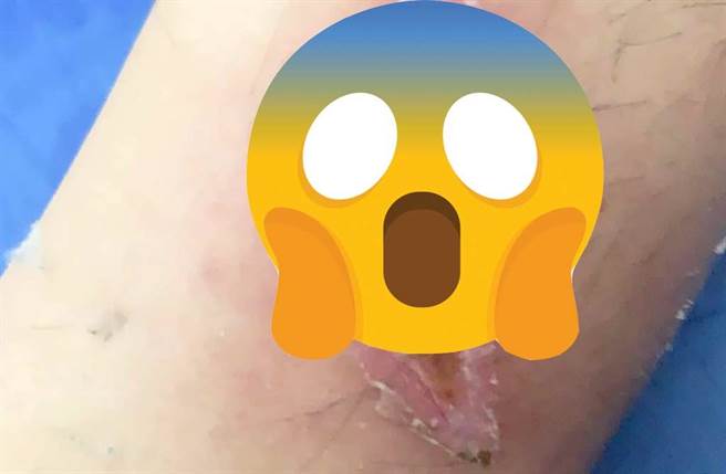 网友哀怨分享自己小腿被机车排气管烫出一个超猛图案。（翻摄脸书私密社团《●【爆怨公社】●》）