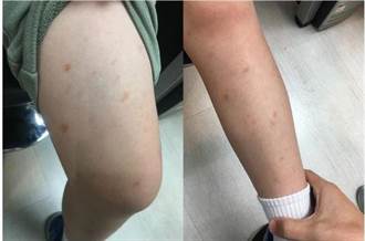 兒童腿部紅疹別輕忽 小心過敏性紫斑症