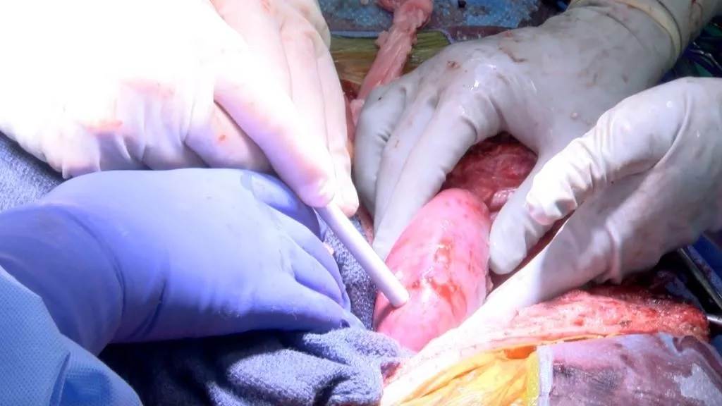 在最近的一项实验中，将基改猪的肾脏，植入脑亡患者体内，实验猪肾能否在人体内运作。图/阿拉巴马大学(photo:ChinaTimes)