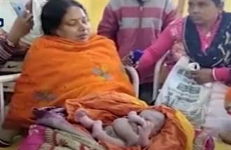 印度出現神嬰 孕婦生出8肢寶寶 臟器外露仍活蹦亂跳