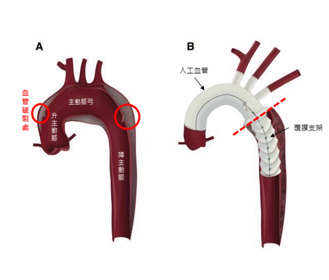 以往手术大多做主动脉弓置换，复合式主动脉人工血管多了一段覆膜支架，可以架到降主动脉(虚线下)，一併将降主动脉问题解决，减少二次手术机会。（恩主公医院提供）