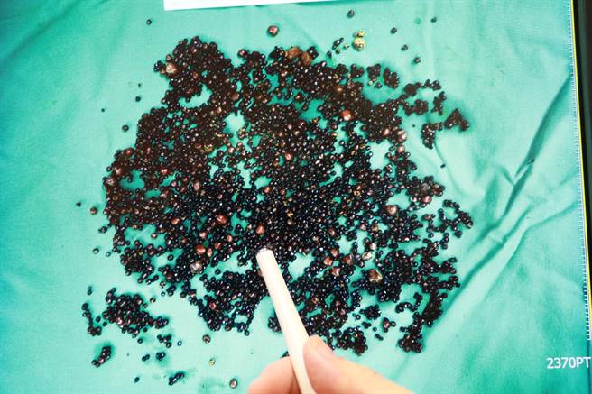 从病人胆囊中取出的胆结石近5000颗，粒粒分明。（台中慈济医院提供／王文吉台中传真）