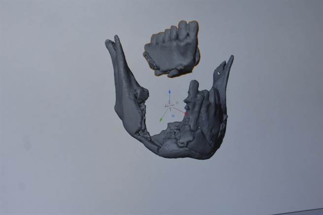 透過3D模擬技術及醫療3D列印輔助，成功重建劉同學下顎，且臉部外觀看起來更好看更帥氣。（彰基提供／謝瓊雲彰化傳真）