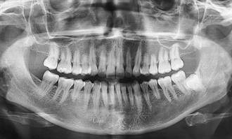 男童長出300顆牙 嘴巴被擠爆 超密集照曝醫師也看傻