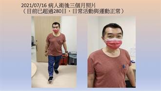 台大完成亞洲首例氣管移植 44歲男重獲新生