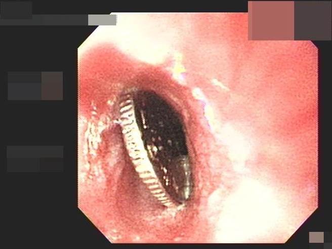 高雄一名2歲男童把小紅包中的一元硬幣當作糖果吞下肚，緊急送醫後，所幸無大礙。（高雄長庚醫院提供／洪浩軒高雄傳真）