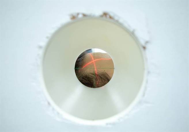 图为脑瘤患者接受BNCT治疗前，需模拟定位找出肿瘤精确的照射位置。(图／远见提供)