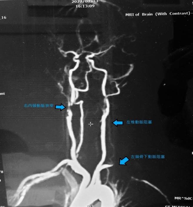 一位70岁老妇因左锁骨下动脉血管阻塞、左椎动脉阻塞、前循环的右内颈动脉狭窄，一转头就头晕昏倒，经诊断后发现是「弓箭手症候群」作祟。（高市民生医院提供／袁庭尧高雄传真）