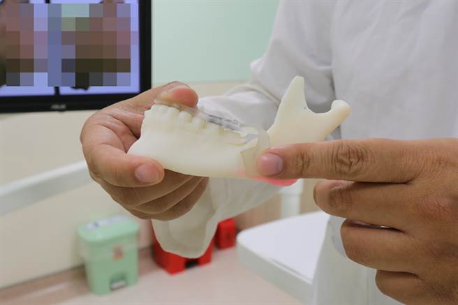 醫師透過人體齒顎模型解釋患者打鼾原因與治療方式。（亞大醫院提供／林欣儀台中傳真）