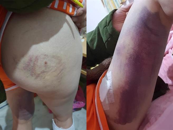 女物流士遭住家衝出3只牧羊犬撕咬，造成她腿部大面积瘀青与身体多处惊悚咬痕，饲主当下还不愿报警，只愿给1万5和解呛说「啊不就送货员…你就去告啊」。（翻摄自脸书「爆料公社」）