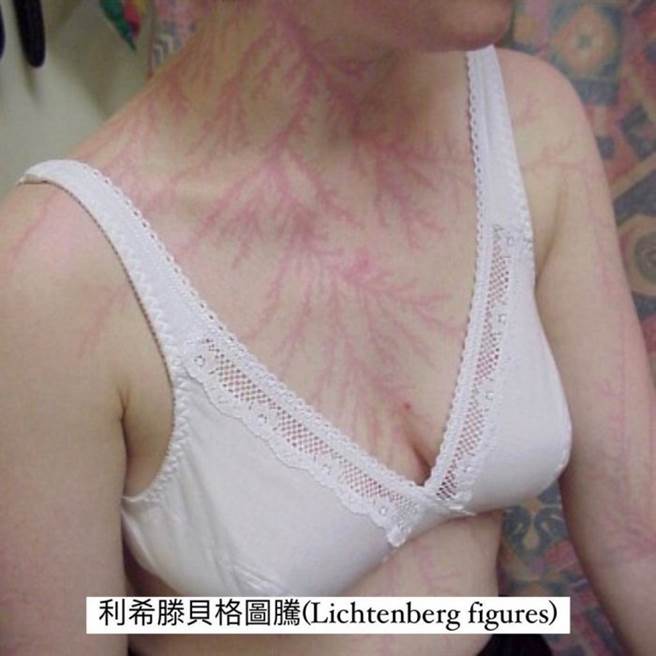 一名英国女子被雷击后仅轻伤，但身上留下大片像是红色蕨类的图腾。(翻摄自阙壮理Dcard)