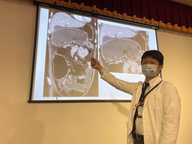 中国附医大肠直肠外科医师蔡元耀指出，赖女士到院时大肠有一个5公分的肿瘤，造成肠严重发炎、阻塞。（冯惠宜摄）