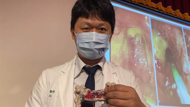 蔡元耀指出，大肠癌造成肠阻塞的病患进入急诊室前，往往因肠阻塞而营养状况不佳，手术发生併发症风险较高，如能先置放大肠金属支架，住院、復原时间大幅缩短。（冯惠宜摄）