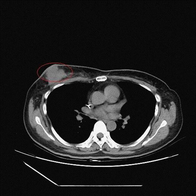 48歲黃小姐至彰化醫院就醫，經電腦斷層檢查顯現乳房腫瘤(紅圈處)。（彰化醫院提供／謝瓊雲彰化傳真）