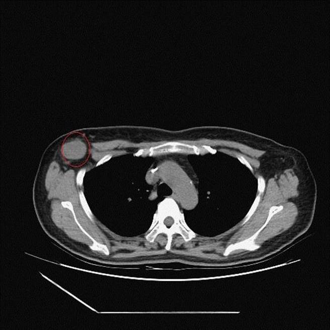 電腦斷層顯現擴散至淋巴結腫瘤(紅圈處)。（彰化醫院提供／謝瓊雲彰化傳真）