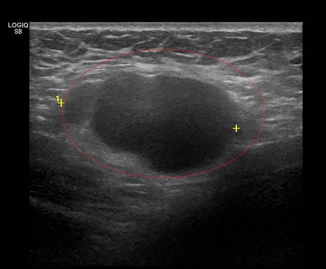 超音波檢查發現淋巴結腫瘤。（彰化醫院提供／謝瓊雲彰化傳真）