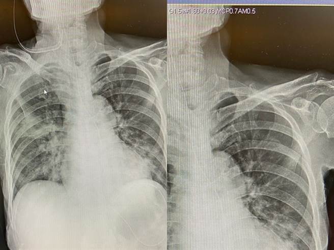 男大生日戴保險套與學姊發生關係，當晚竟「全身重傷」，他PO出X光照片，稱自己頭皮撕裂傷、右手斷掉，最後曝光原因，原來他是被「學姊男友」打傷。（翻攝自Dcard）