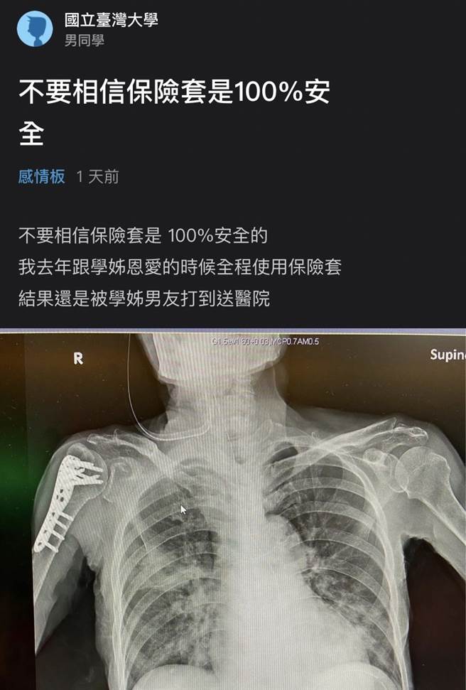 男大生日戴保險套與學姊發生關係，當晚竟「全身重傷」，他PO出X光照片，稱自己頭皮撕裂傷、右手斷掉，最後曝光原因，原來他是被「學姊男友」打傷。（翻攝自Dcard）