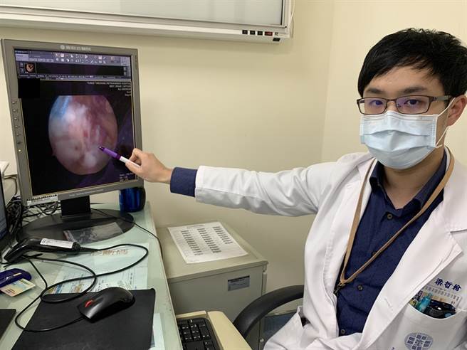童綜合醫院骨科醫師梁哲翰筆指處為旋轉肌袖破裂處，已進行微創肩關節內視鏡肌腱修補手術。（陳淑娥攝）