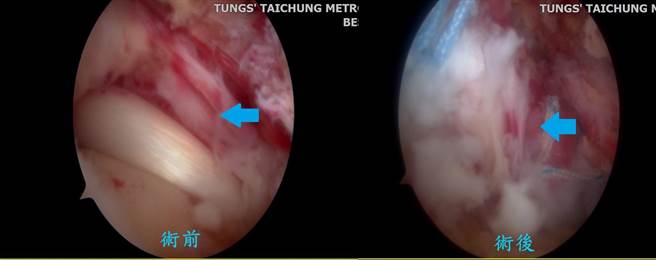 旋轉肌袖破裂手術修補前後照片。（童綜合醫院提供／陳淑娥台中傳真）