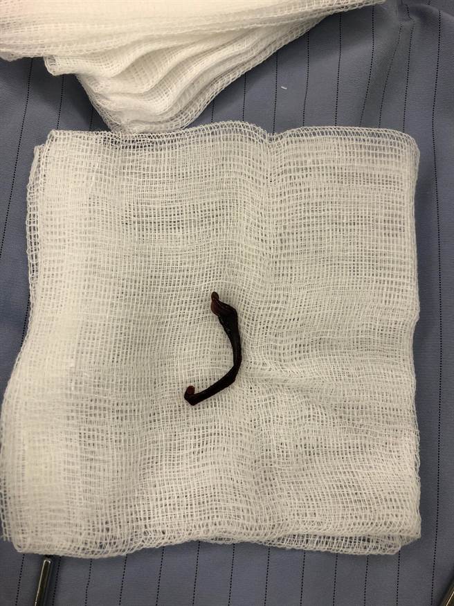 花莲1名2岁余姓女童连续2周出现间歇性流鼻血，经耳鼻喉科内视镜检查，发现鼻腔内有条近2公分的鼻蛭在游走，所幸就医后顺利将鼻蛭取出，女童也在治疗后恢復正常。（慈济医院提供／罗亦晽花莲传真）