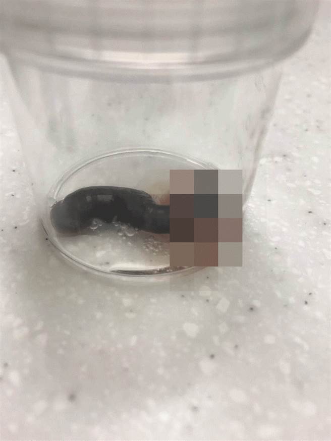 花莲1名2岁余姓女童连续2周出现间歇性流鼻血，经耳鼻喉科内视镜检查，发现鼻腔内有条近2公分的鼻蛭在游走，所幸就医后顺利将鼻蛭取出，女童也在治疗后恢復正常。（慈济医院提供／罗亦晽花莲传真）