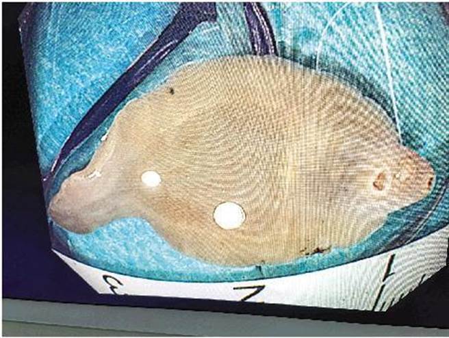 女腹痛驚見「魚型寄生蟲」，醫撿查發現患者肝臟被啃了3分之1。（圖／翻攝自桂林日報）