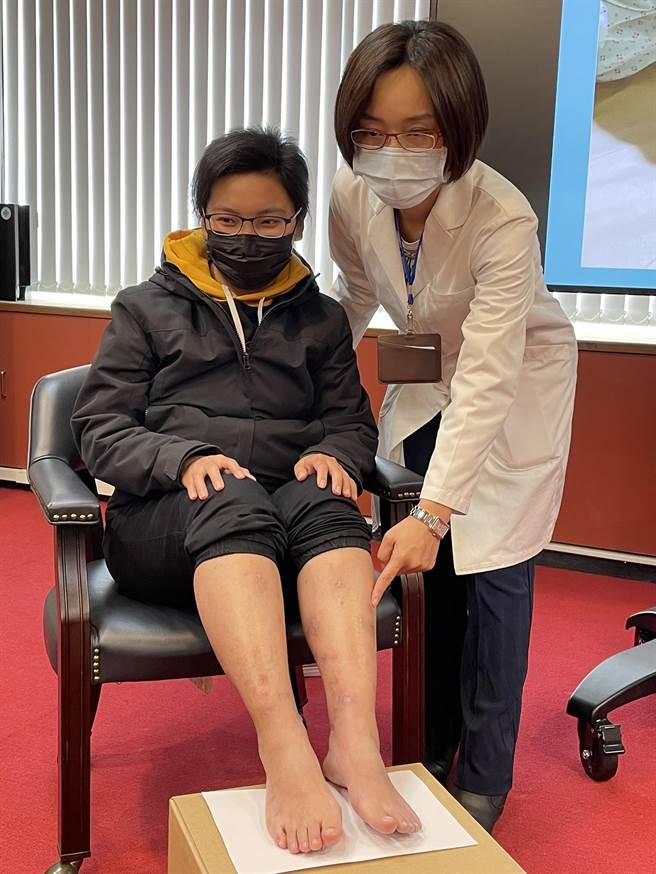 患者许小姐（左），去年1月因下肢水肿和多处红斑及伤口，并发生急性肾损伤、肺水肿到医院急诊，被确诊为「高安氏动脉炎」罕见疾病。（台中荣总提供／张妍溱台中传真）